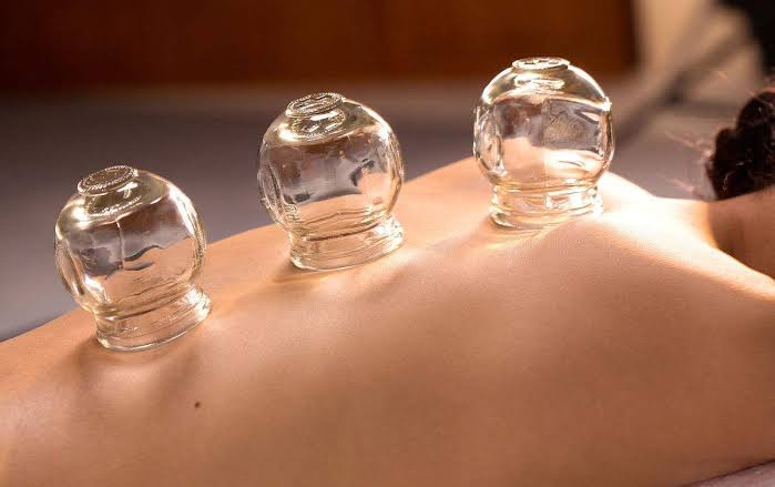 Cupping Therapy on the Upper East Side, NYC